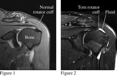 test dr can do in office for muscle tear|mri for torn muscles.